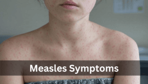 Measles Symptoms